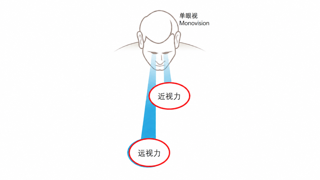 角膜屈光手术.png